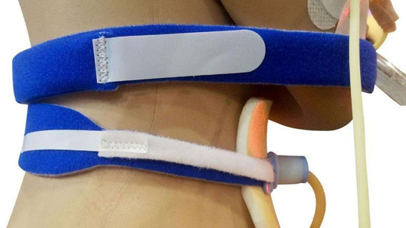 Tracheostomy Tube Holders for Stabilization